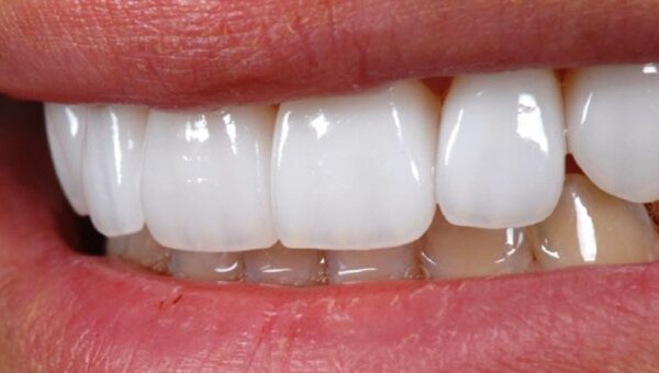 Faccette dentali: quali sono i vantaggi?